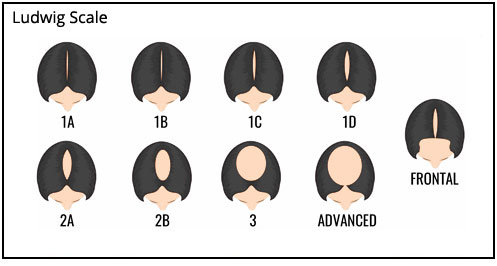 Hair Loss Chart Norwood