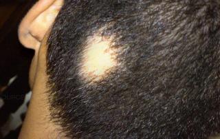 Alopecia Areata hair loss