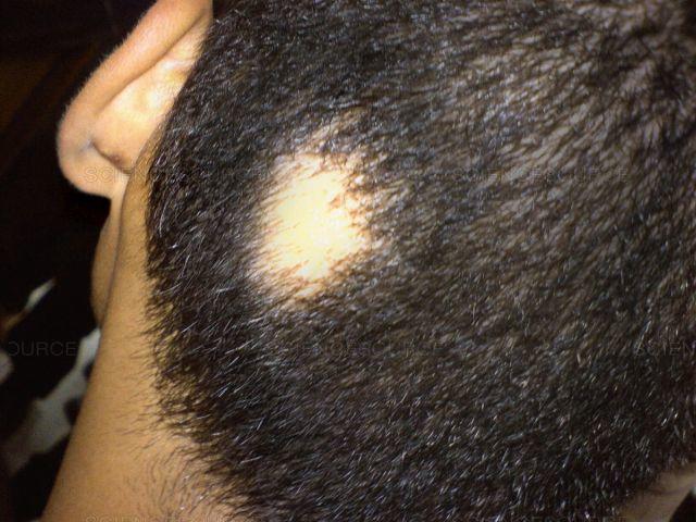 Alopecia Areata hair loss