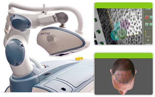 Artas Robotic Hair Transplants: A Closer Look - PAI Hair Restoration McLean  Virginia