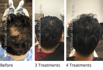 EPT Mens Hair Loss Treatment McLean VA