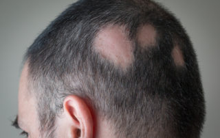 alopecia areata treatment washington dc