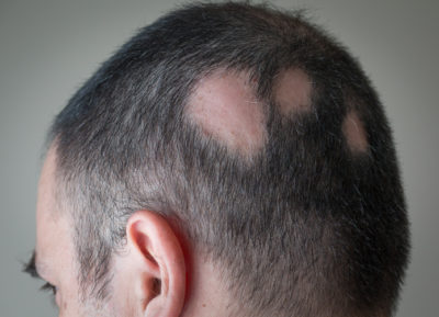 alopecia areata treatment washington dc