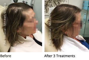 PRP Hair loss treatment therapy McLean Virginia