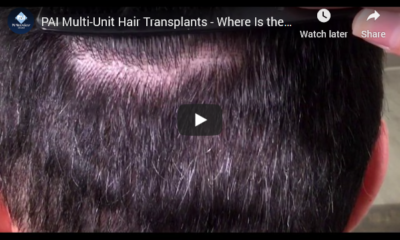 Larry OConnor WMAL Radio Hair Transplant McLean Arlington VA