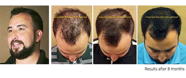 laser hair loss treatment therapy results washington dc northern virginia
