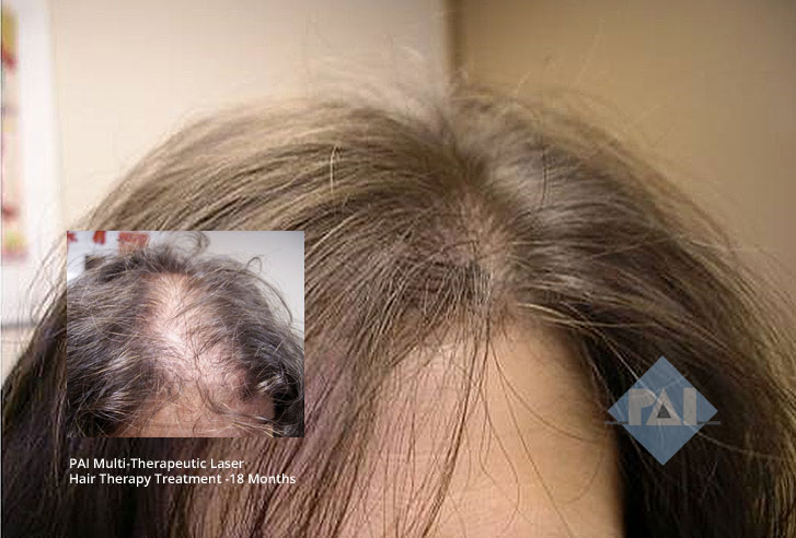 PAI Laser Hair Loss Alopecia Treatment McLean VA Baltimore MD