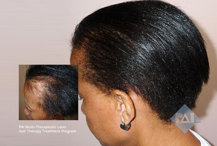 Can Hair Loss Be Reversible? - PAI Hair Restoration McLean Virginia