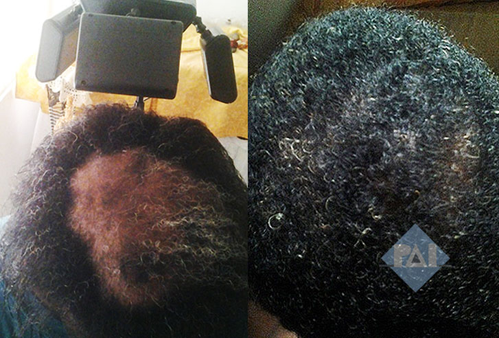 african american laser hair loss treatment arlington virginia washington dc