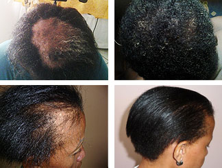 Laser Hair Loss Therapy Treatment | Non-Surgical Treatment for Hair Loss