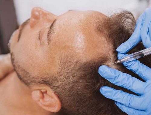 What Makes EPT Effective for Treating Hair Loss