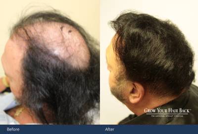 hair transplants norther virginia washdc